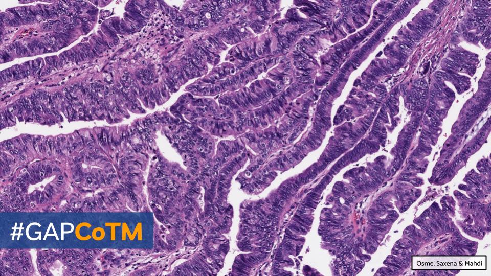 GAPathologists's tweet photo. GAP CASE OF THE MONTH #16:
75βοΈ w/ acute epigastric pain. Gallbladder shows wall thickening, polypoid lesions.
By: Drs. Abdullah Osme, Romil Saxena & Zaid Mahdi
π¬ WSI: https://t.co/t8ars9eU93
π‘ Answer: https://t.co/OA4CaPRT3g
#GAPCoTM #gipath #hemepath @EmoryPathology https://t.co/gaMJqfmR8g