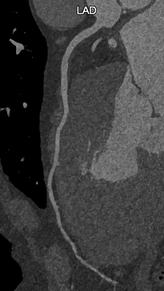 STATE OF THE ART PHOTON COUNTING CT Coronary artery imaging is very important in clinical practice for diagnostic and therapeutic purposes. Ex. 768x768 matrix CCT of a LAD with 0.2mm/0.1mm. Kernel Bv72. QIR 4.