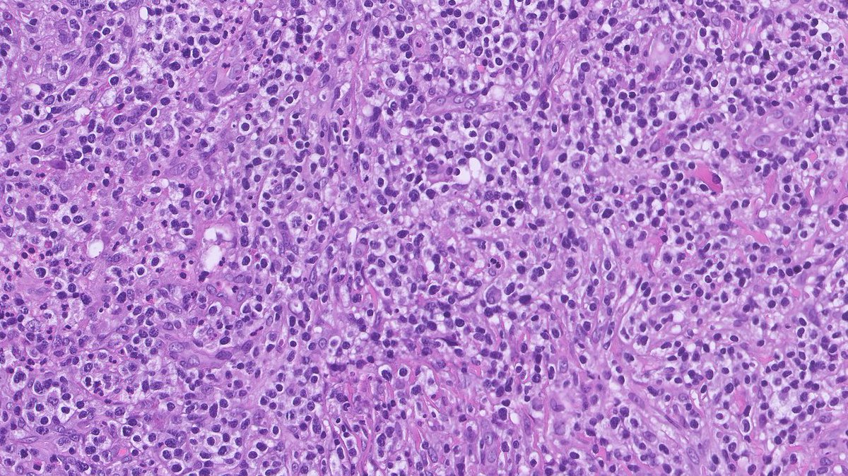 LN 76 yo. Can u make a diagnosis from the H&amp;E?