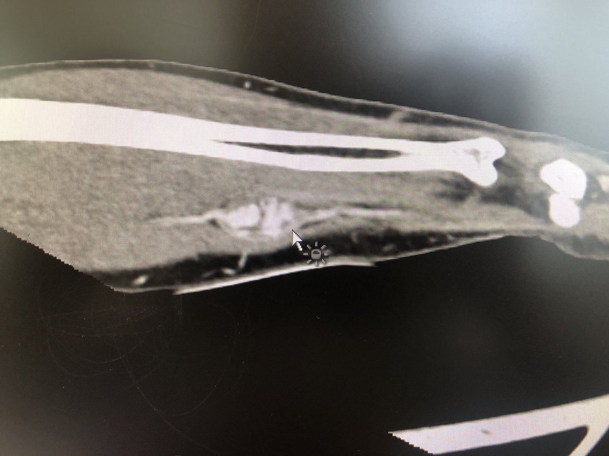 alla_ajten's tweet photo. #rheumtwitter 
#MedTwitter 
👉rare causes of inflammatory hand pain
25yo male pain right wrist, sensitive complaints in n.ulnaris area, no arthritis. ANF, RF, anti-CCP neg. 
👉Vascular malformation-aneurysm of a.ulnaris https://t.co/NR24QHdcVk