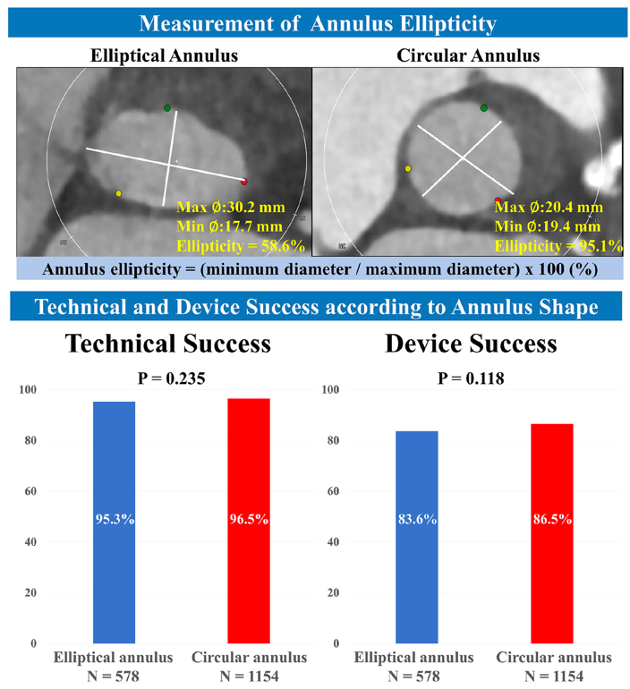 Thomas Pilgrim (@thompilgrim) on Twitter photo In an analysis of 1732 TAVI patients, ellipticity of the aortic annulus did not affect procedural and device outcomes irrespective of transcatheter heart valve design and generation. doi.org/10.1002/ccd.30…
<a href="/DaijiroTomii/">Daijiro Tomii</a> <a href="/taishiokuno/">Taishi Okuno</a> <a href="/StefanStortecky/">Stefan Stortecky</a> In an analysis of 1732 TAVI patients, ellipticity of the aortic annulus did not affect procedural and device outcomes irrespective of transcatheter heart valve design and generation. doi.org/10.1002/ccd.30…
<a href="/DaijiroTomii/">Daijiro Tomii</a> <a href="/taishiokuno/">Taishi Okuno</a> <a href="/StefanStortecky/">Stefan Stortecky</a>