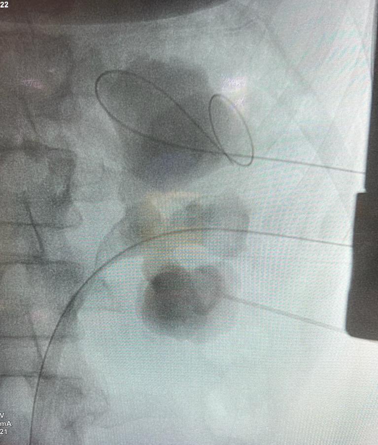 GuidoGiusti's tweet photo. I’m strongly convinced that sometimes more (aggressive) is  less (invasive) .. in presence of a big #staghorn #renalstone only doing such aggressive #PCNL  u can offer good clearance with acceptable complication rate. having a great team as I luckly have @ #ETCE is also crucial! https://t.co/h3gbiMoHT4