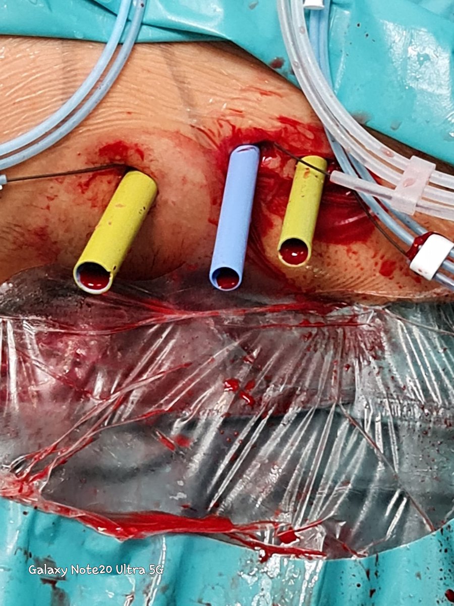 GuidoGiusti's tweet photo. I’m strongly convinced that sometimes more (aggressive) is  less (invasive) .. in presence of a big #staghorn #renalstone only doing such aggressive #PCNL  u can offer good clearance with acceptable complication rate. having a great team as I luckly have @ #ETCE is also crucial! https://t.co/h3gbiMoHT4