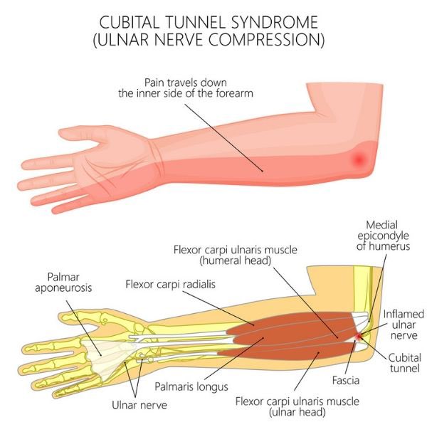 Ulnar nerve entrapment or cubital tunnel syndrome occurs when the ulnar nerve is compressed. Symptoms for this syndrome can be felt with numbness in the ring and pinky fingers. Do you know anyone with this syndrome? #ulnarnerve #msd