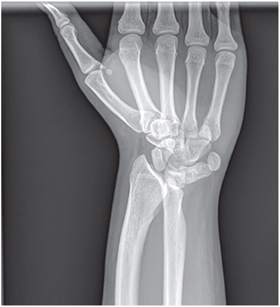 La deformidad de #Madelung afecta a la #muñeca y se caracteriza por las angulaciones radial y palmar de la región distal del #radio. La causa es la detención del crecimiento de los lados palmar y cubital de la metáfisis distal del radio. 📚Nelson. Tratado de pediatría © 2020.