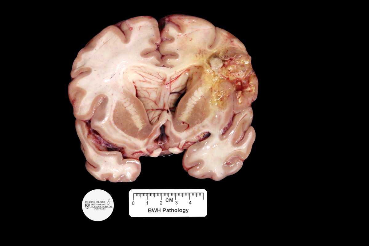 Hello and welcome to the Gross Case of the Week – Neuro Winter Edition! This week we have a case with lesion from autopsy. Can you guess the mass pictured here? #GrossCOTW #NeuroWinter