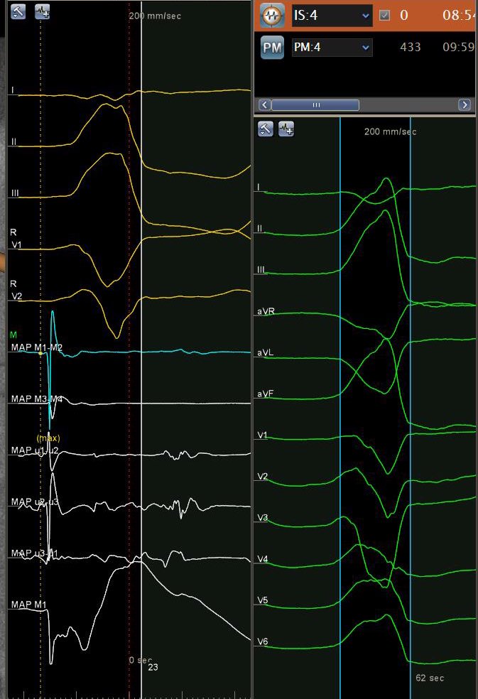 ChristianHeeger's tweet photo. @EPeeps what’s your opinion? What’s the origin of this frequent PVC? Map and answer will be present tomorrow. #RhythmoRiddle @Dominik_Linz @AlexGPott @RolandTilz @chris_sohns @MdJakubBaran @Mel_Gunawardene @DavidDuncker @BA_Mulder @BobWeijs https://t.co/CrdxhegMc1