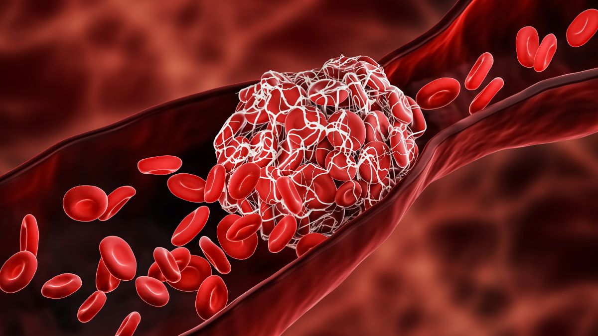 Healthcare providers: Wrap up the year with a free e-learning course on venous thromboembolism (VTE). Learn the signs and symptoms, risk factors, and best practices in treating and managing #VTE. CE credits are available. bit.ly/2ssnvGB