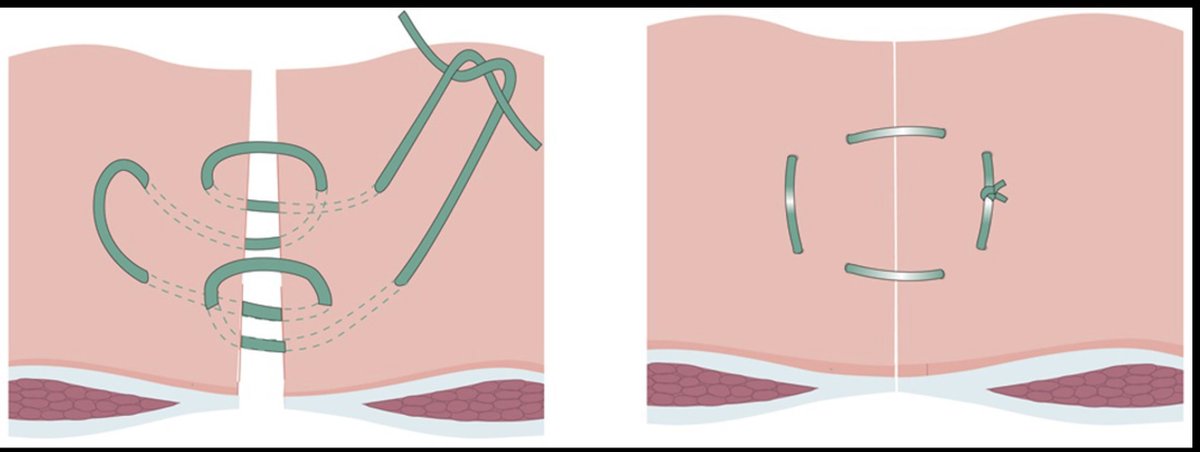 Peter Vaughan-Shaw (@pvaughanshaw) on Twitter photo Hughes Abdominal Repair (far–near–near–far x2) does not ⬇️incisional #hernia after colorectal cancer surgery. Rates at 2yrs very high: 28.7% (Hughes repair) vs. 31.8% (P=0.429). How else can we prevent hernia? doi.org/10.1093/bjs/zn… <a href="/BritishHernia/">British Hernia Society</a> <a href="/HART_trial/">HART Trial</a> <a href="/ACPGBI/">@ACPGBI</a> <a href="/BJSurgery/">BJS</a> Hughes Abdominal Repair (far–near–near–far x2) does not ⬇️incisional #hernia after colorectal cancer surgery. Rates at 2yrs very high: 28.7% (Hughes repair) vs. 31.8% (P=0.429). How else can we prevent hernia? doi.org/10.1093/bjs/zn… <a href="/BritishHernia/">British Hernia Society</a> <a href="/HART_trial/">HART Trial</a> <a href="/ACPGBI/">@ACPGBI</a> <a href="/BJSurgery/">BJS</a>
