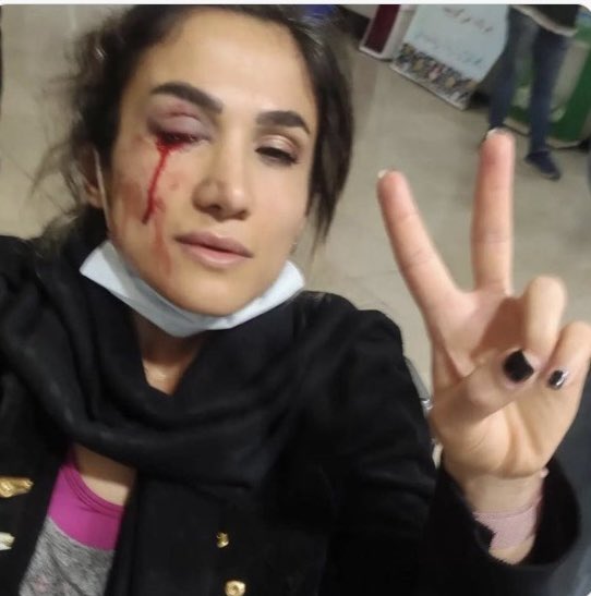 AlinejadMasih's tweet photo. There are credible reports that the regime’s militia has been instructed to directly target the eyes of protesters. 

There are hundreds cases of protesters blinded by the regime. 

The international community should not leave us alone. 

#IranRevolution https://t.co/WhhALTAy0S