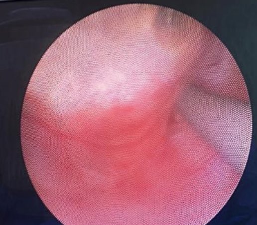 Long date ureteral calculus in epithelization process. Take care in not perforate the ureter during lithotripsy.  #UroSoMe