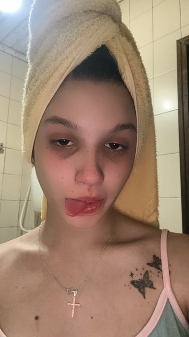 Pq q qd eu choro embaixo do meu nariz fica com hematoma? https://t.co/Aqvn2xGZx1