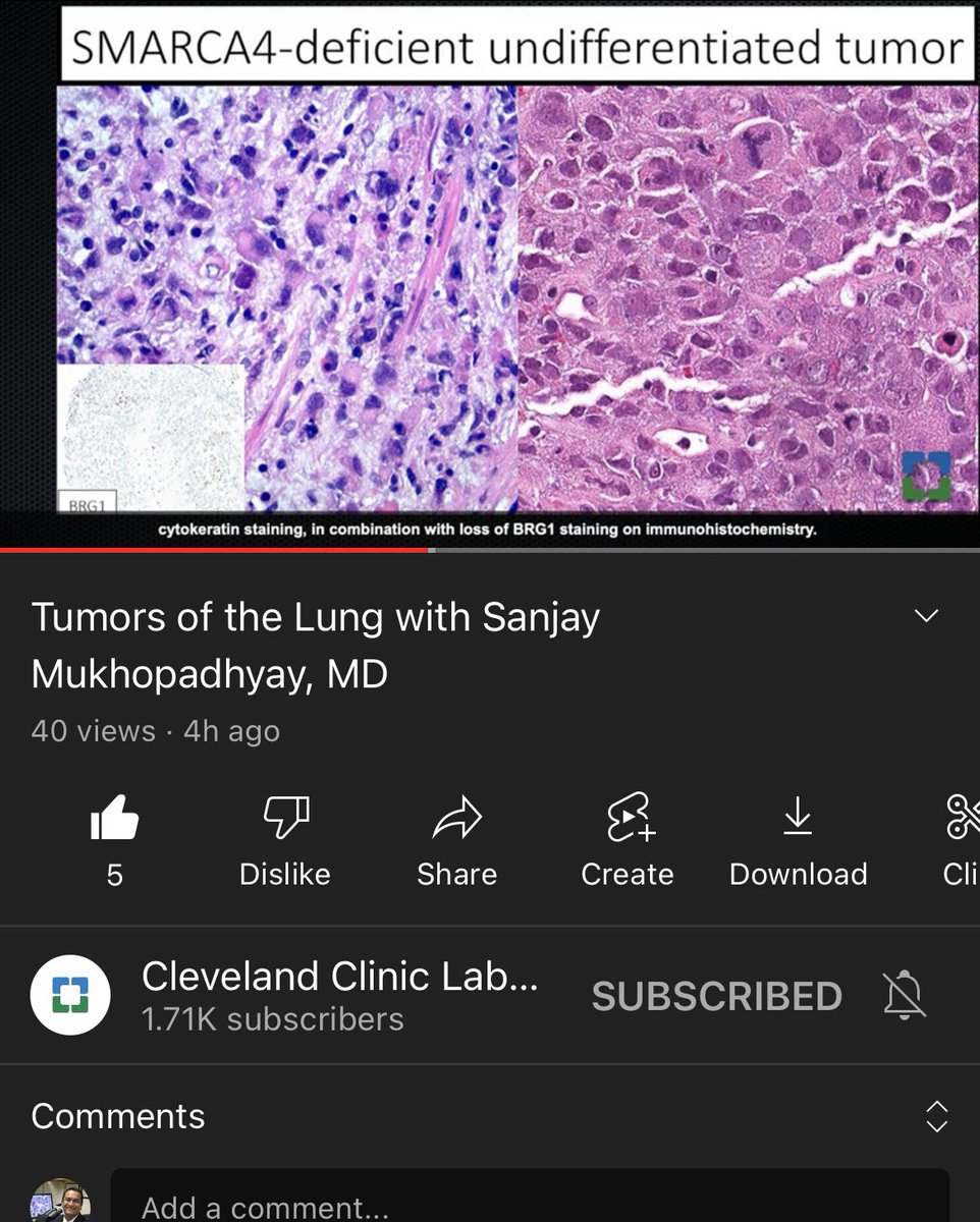 Sanjay Mukhopadhyay (@smlungpathguy) on Twitter photo Please watch this 🔥 new #pulmpath video from <a href="/CLEClinicLabs/">ClevelandClinicLabs</a>
👉🏾 quick overview of ALL the lung tumors in the 2021 WHO book
👉🏾 high quality pics
👉🏾 great review/update for residents
👉🏾 FREE & open access on YouTube
youtu.be/4DzXgspyFwc
#pathology #pulmpath #lungcancer Please watch this 🔥 new #pulmpath video from <a href="/CLEClinicLabs/">ClevelandClinicLabs</a>
👉🏾 quick overview of ALL the lung tumors in the 2021 WHO book
👉🏾 high quality pics
👉🏾 great review/update for residents
👉🏾 FREE & open access on YouTube
youtu.be/4DzXgspyFwc
#pathology #pulmpath #lungcancer