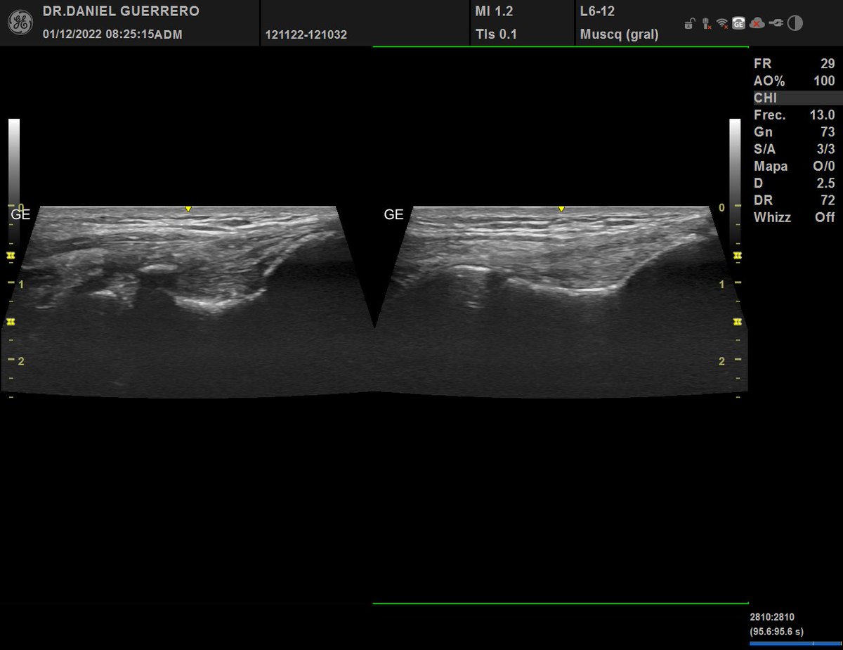 Lesion crónica de ligamento colateral ulnar codo, afectado y sano