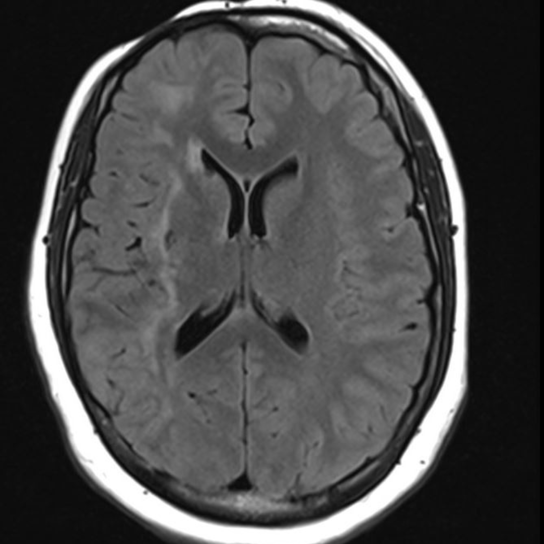Parry Romberg syndrome
Slowly progressive facial hemiatrophy. It can be associated with brain changes as well. Etiology unknown but thought to be autoimmune. Patients can present with seizures and migraines.
Green arrows show asymmetry between both sides.

#Neurology