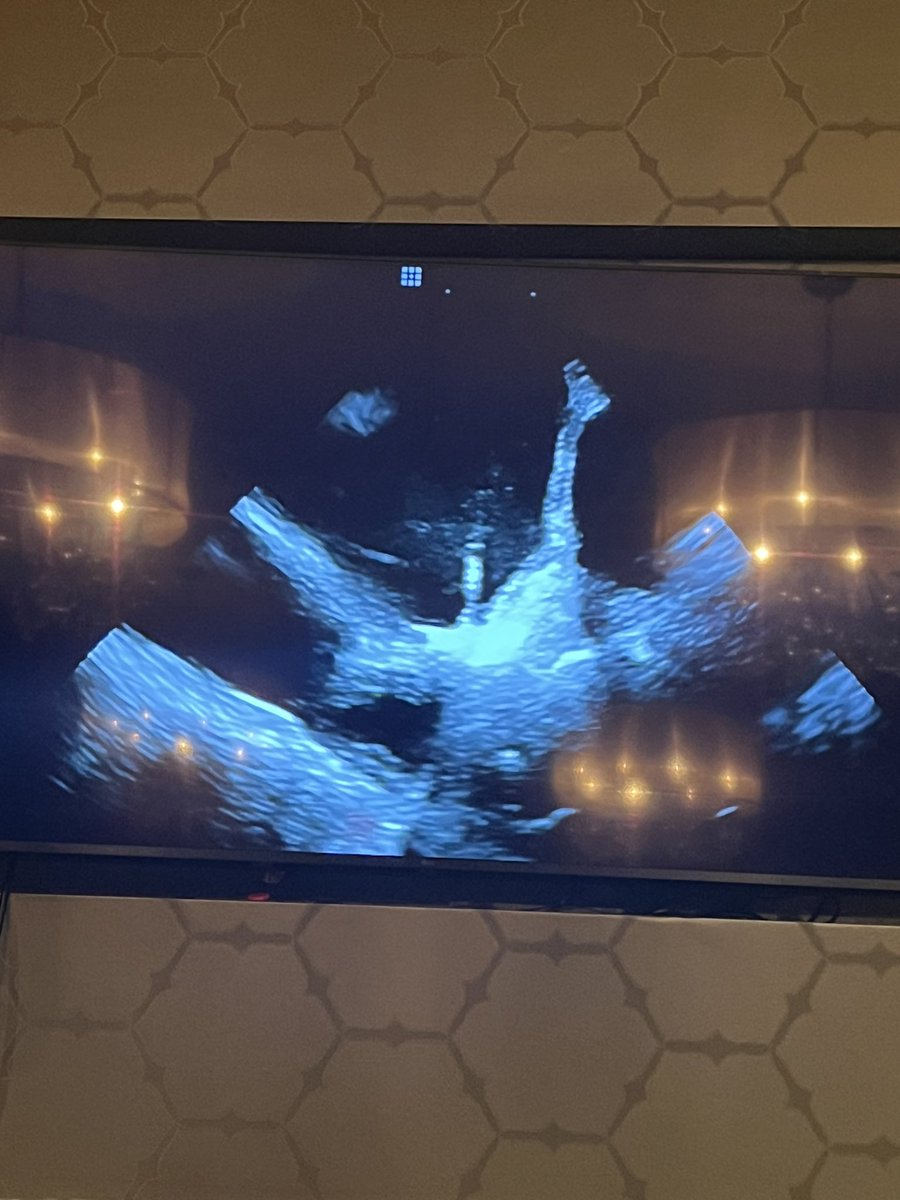 JasneetDevgun's tweet photo. We @HFHCardioFellow had the honor of hosting ❄️#ICE ❄️master 🤺@MRazminia tonight! Incredible lecture on 🚫 fluoro
⭐️Beat #Afib w/less 🔥
⭐️Say ✌️to that #PVC
⭐️👀+🛑 that clot b4 the 🧠
I mean…just look at that burn!! 🔥🫣
#EPeeps #CardioTwitter #ablate #SaveYourBack https://t.co/ykehEDpH4w