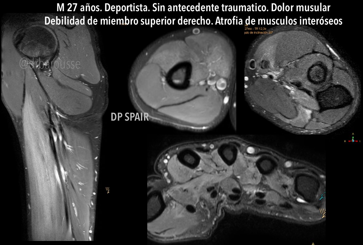 27 years old male. Practices sports. No history of trauma. Muscular pain. Weakness of right upper limb. Atrophy of interosseous muscles. Which is the diagnosis?