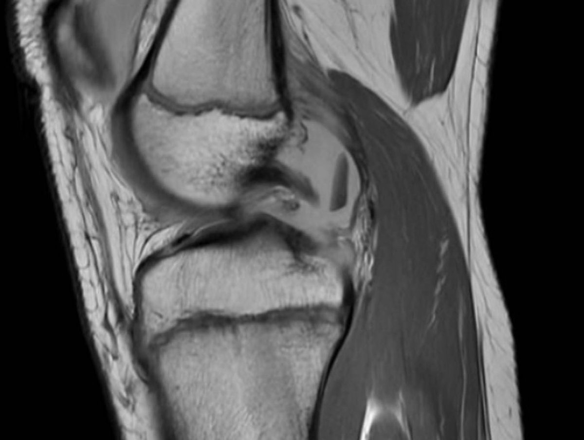DraIsaGuillen's tweet photo. 📋Paciente de 12 años:
⚽Jugando al #fútbol nota 💥dolor y crujido tras un giro, acude a urgencias con bloqueo
🩻#LesiónCondral desprendida en tróclea femoral externa🦵🏼
🥼Fijación de fragmento y toma de biopsia de #cartílago 🧫#preICC por si no se incorpora

@iccimplanteC #ICC https://t.co/Eu5Q1zo46l