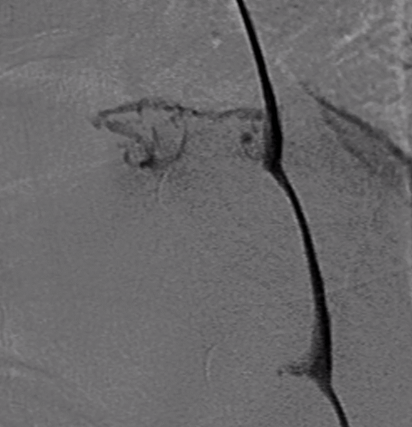 Barts Health Interventional Neuroradiology tweet media