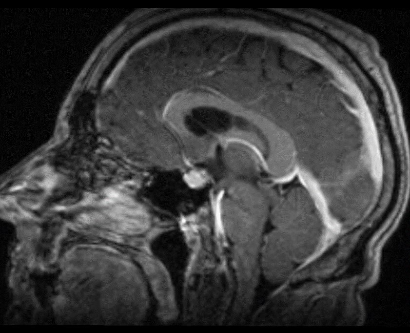 Barts Health Interventional Neuroradiology tweet media