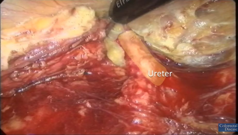 Colorectal Disease tweet media