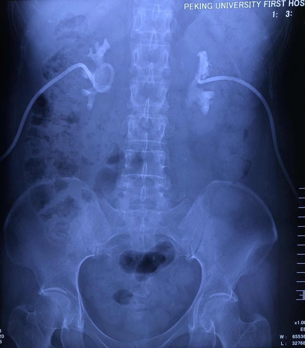 yang_kunlin's tweet photo. RA bilateral total ileal ureteral replacement with extracorporeal ileal management (Y-shaped). Thanks to Dr. XS Li to teach us a lot. 2 positions, 3 dockings (1 left dissection, 1 left anastomosis, 1 right dissection+right anastomosis+ilealvesical anastomosis) https://t.co/9tE4n7Juy2