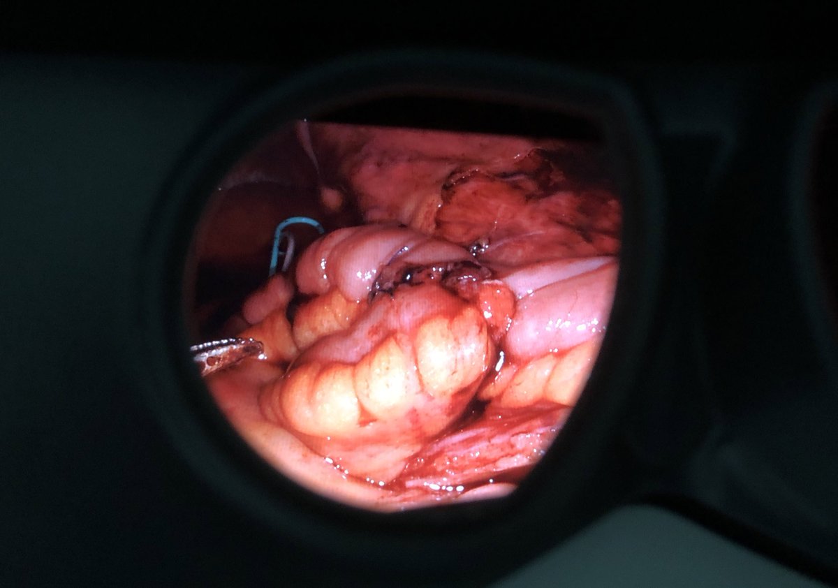 yang_kunlin's tweet photo. RA bilateral total ileal ureteral replacement with extracorporeal ileal management (Y-shaped). Thanks to Dr. XS Li to teach us a lot. 2 positions, 3 dockings (1 left dissection, 1 left anastomosis, 1 right dissection+right anastomosis+ilealvesical anastomosis) https://t.co/9tE4n7Juy2