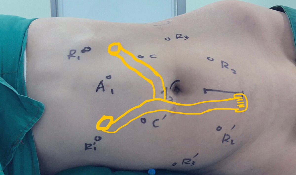 yang_kunlin's tweet photo. RA bilateral total ileal ureteral replacement with extracorporeal ileal management (Y-shaped). Thanks to Dr. XS Li to teach us a lot. 2 positions, 3 dockings (1 left dissection, 1 left anastomosis, 1 right dissection+right anastomosis+ilealvesical anastomosis) https://t.co/9tE4n7Juy2
