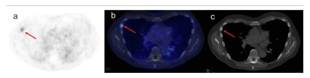 EUplatinum's tweet photo. Incorporating PSMA PET in Management Decisions for Men with Newly Diagnosed or Biochemically Recurrent Prostate Cancer 

https://t.co/52K7hr9Slq 

@LauraBukavinaMD @AmyLuckenbaugh @DrMHofman @sophia_kamran @declangmurphy @KOSJ12 @piet_ost https://t.co/0sPSRmxh6M