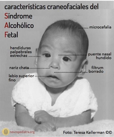 SindromeAF's tweet photo. Cuidemos a nuestros futuros bebés, NO tomes alcohol durante el embarazo https://t.co/tSBNHWZvmX
