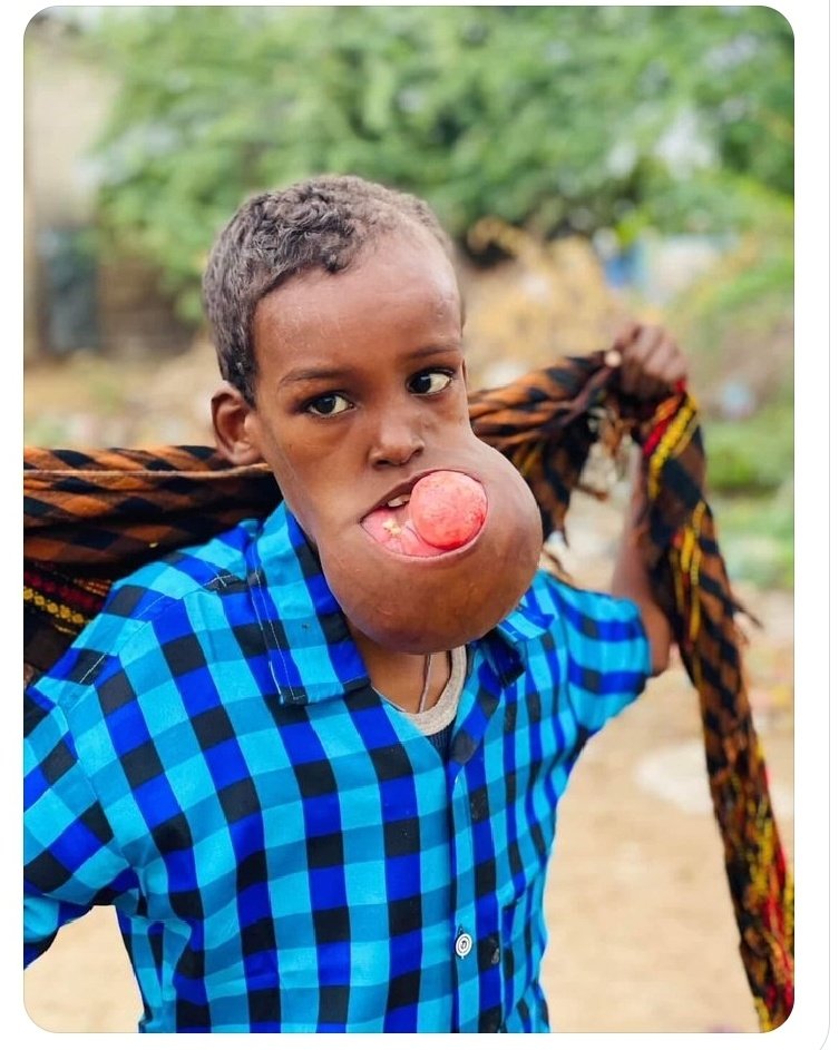 #NorwayStopDumpingWasteInSomalia
In Somalia there are no environmental pollutants. However, the rates of tumors, cancers, unknown and rare diseases have increased in the last two decades, because the likes of <a href="/NorwayInSomalia/">Norway in Somalia</a>🇳🇴 have made our ocean full of their dirty waste!