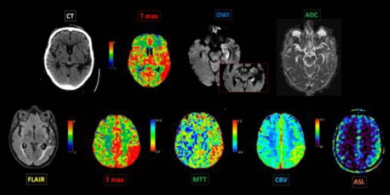 SERAM_RX's tweet photo. 📄#TC perfusión #Cerebral: ¿Qué es real y qué no lo es?
🔎Los autores del #PiperSERAM analizan cuáles son las alteraciones del TC de perfusión que se asocian con más frecuencia a los #StrokeMimics
¡No te lo pierdas!▶️https://t.co/94FvnZw8Rx https://t.co/LrLgA26TQs