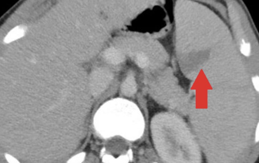 What is seen here?  Abscess, infarct, or tumor?  #foamrad #MedTwitter #radtwitter #radres #radiology (Image: Cureus)