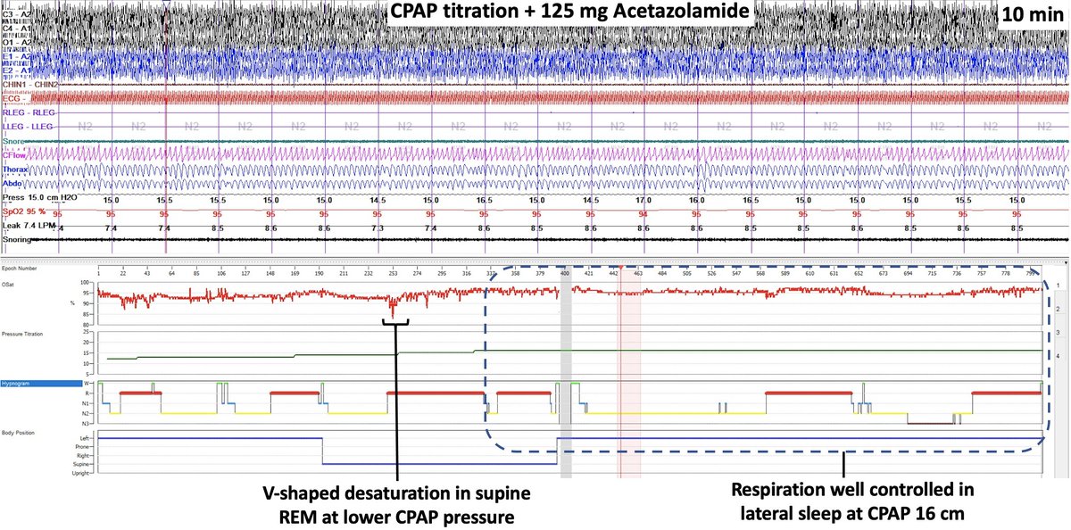 SleepyNeuroDoc's tweet photo. PSG titration with #CPAP + 125mg acetazolamide QHS. In the lateral position, respiration is well controlled at 16cm. The patient reported one of the best nights of sleep ever, and excessive daytime sleepiness completely resolved the next day! 🙌🙌 #Apnea #LoopGain #Diamox https://t.co/clP6kGm8Tn