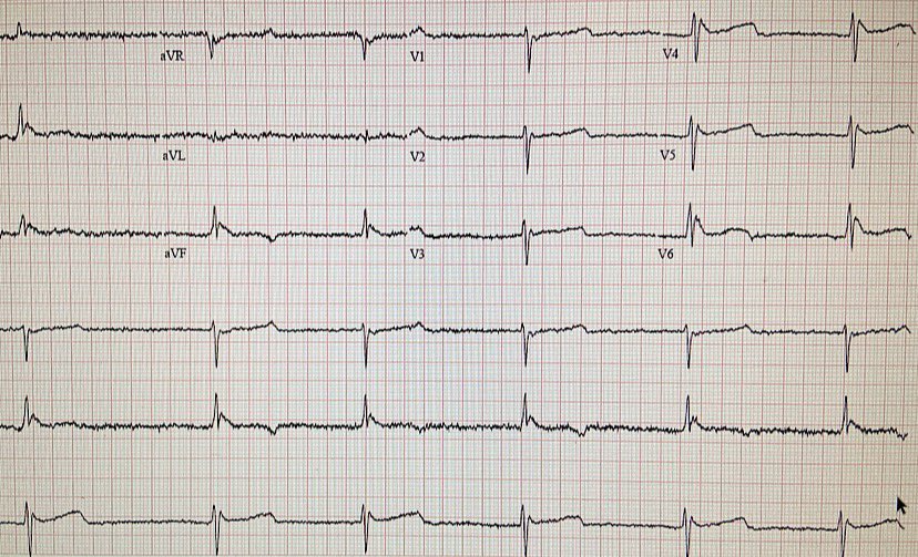 If you work in the ED in Chicago get comfortable with recognizing this ekg.  Patient was found down outside and obtunded. 2 classic findings here.