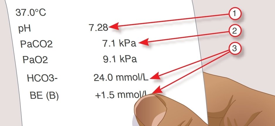Here is my attempt at an entry-level blood gas analysis tweetorial for those new to critical care...

Here's our typical normal values...
pH 7.35-7.45
PaCO2  4.5-6kPa
PaO2 10-13kPa
HC03 22-26mmol/L
Base Excess -2.5 to +2.5 mmol/L

1. What's happening here?