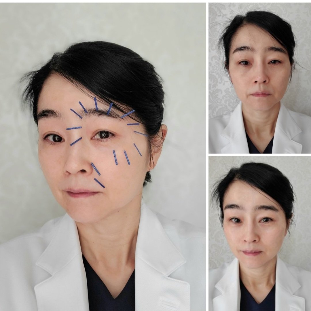 masuimiho1006's tweet photo. #cosmeticacupuncture for
#eyebrows lowered and #facial
#眉が下がってきた #顔が下がってきた
#顔のたるみ #目元 #左右対象 #美顔 #美容鍼 #目元の衰え #symmetry
#symmetrical #symmetricalface #鍼灸 #eyecare #facialtreatment #fights
#skincare #フェイシャルサロン
#フェイシャルエステ https://t.co/S8EUHYqfEJ