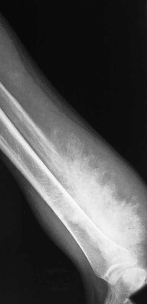 BrownJHM's tweet photo. A 20 year old man presented with lower leg pain associated with soft tissue swelling. What is the likely diagnosis? (Image @Radiopaedia, Dr. Aditya Shetty) #Medtwitter https://t.co/1Dxpzbhb79
