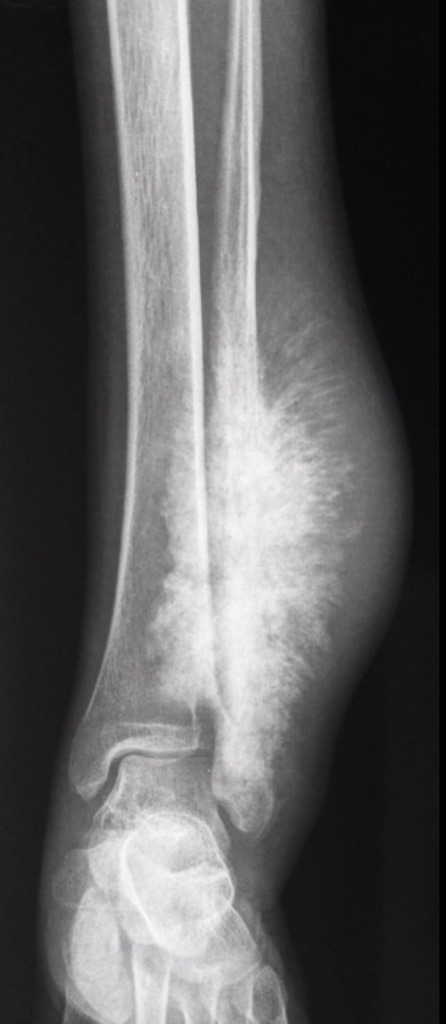 BrownJHM's tweet photo. A 20 year old man presented with lower leg pain associated with soft tissue swelling. What is the likely diagnosis? (Image @Radiopaedia, Dr. Aditya Shetty) #Medtwitter https://t.co/1Dxpzbhb79