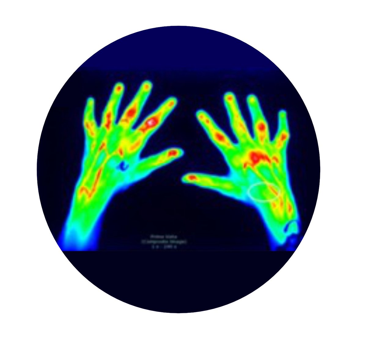RheumJnl's tweet photo. Time for #RheumOff ! Vote for the cover of Rheumatology Vol 62!
1️⃣ FOI of RA patient https://t.co/w1hMulkvl4 by Ammitzbøll-Danielsen et al
🆚
2️⃣ Radiograph of bilateral shortening of metacarpal and phalanx bones
https://t.co/JQik4LFkqY by @DrPintoSaraiva et al
Poll below👇 https://t.co/HlnVXY3YU6