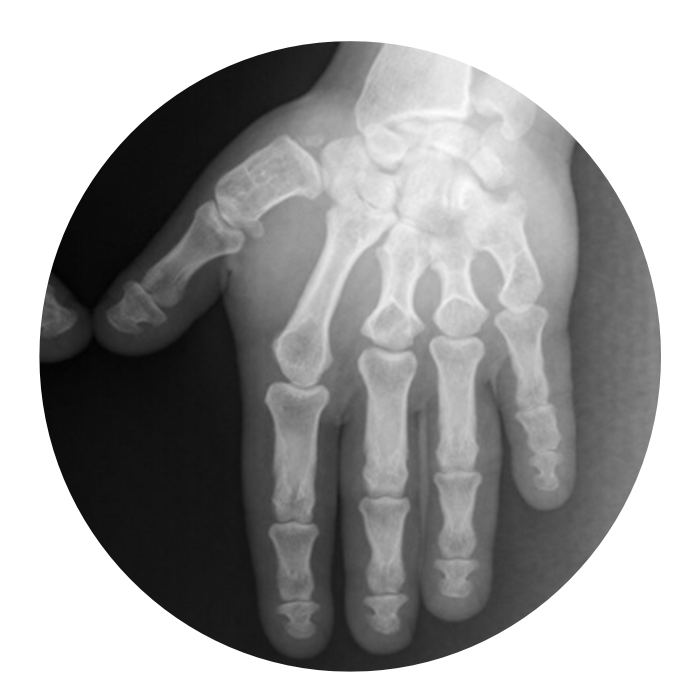 RheumJnl's tweet photo. Time for #RheumOff ! Vote for the cover of Rheumatology Vol 62!
1️⃣ FOI of RA patient https://t.co/w1hMulkvl4 by Ammitzbøll-Danielsen et al
🆚
2️⃣ Radiograph of bilateral shortening of metacarpal and phalanx bones
https://t.co/JQik4LFkqY by @DrPintoSaraiva et al
Poll below👇 https://t.co/HlnVXY3YU6