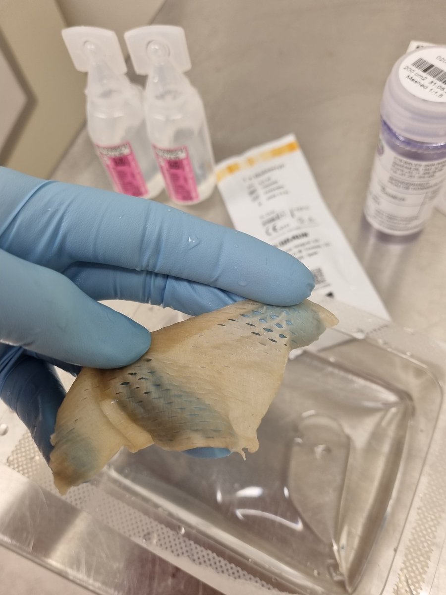 Voorbeiding voor een wondbehandeling met #donorhuid. De glycerol moet goed uitgespoeld worden voor applicatie.
Donorhuid is een tijdelijk biologisch verband dat granulatie bevordert, beschermt tegen uitdroging, infectie en pijn reduceert. #altijdleukklusje
#wecmst