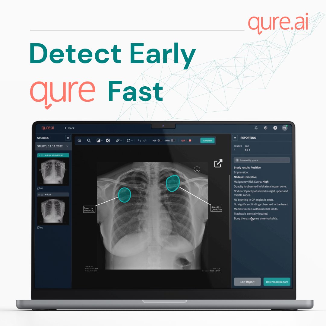 qure_ai's tweet photo. #DetectEarlyQureFast #mondaypost
qXR - AI for Lung Cancer - a highlight🧵
☑️Can accurately detect lung nodules
☑️Analysis & Risk Assessment of Nodule
☑️Enhances outcomes for patients through early detection
Also check out https://t.co/A6G2if3vVu https://t.co/EVfwH0tYz0