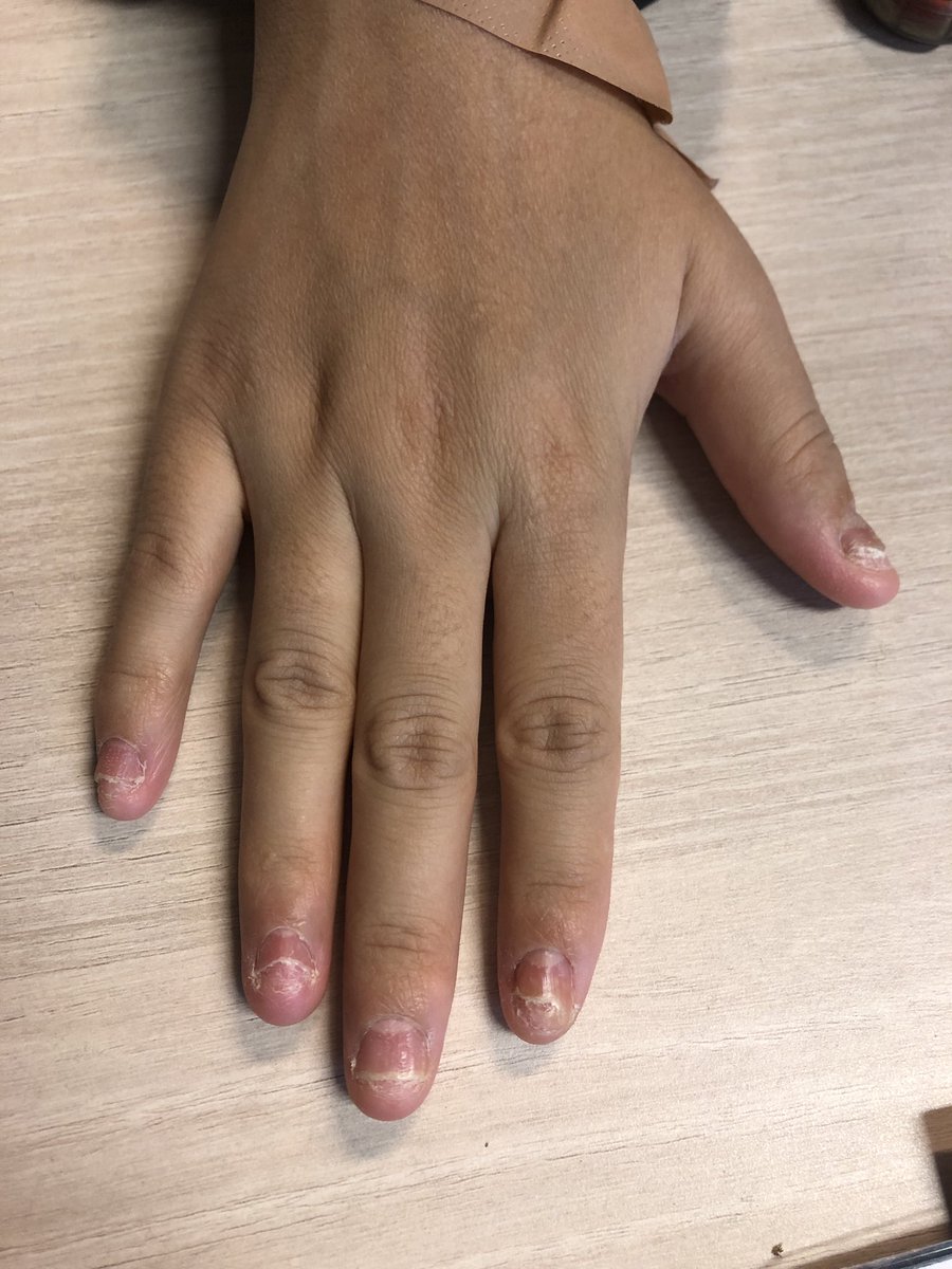 alla_ajten's tweet photo. #medtwitter nail #psoriasis 
Which finger is swollen? 
Severe nail psoriasis- sometimes difficult to treat due to limitation in reimbursement criteria of biologicals https://t.co/bPHj9LK8M9