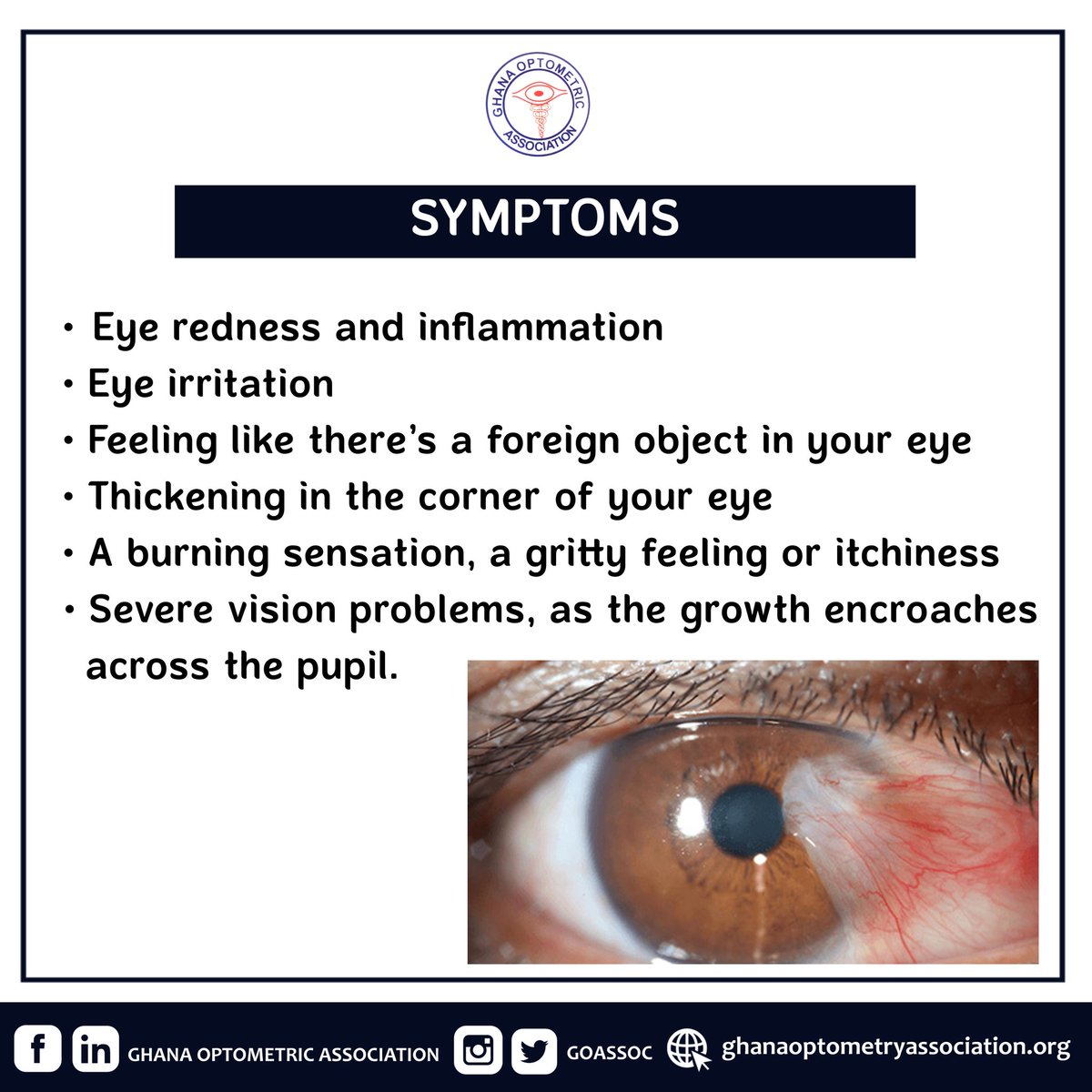 GOAssoc's tweet photo. Our condition of the week is PTERYGIUM! 

A pterygium is a growth of pink fleshy tissue on the conjunctiva, the clear tissue that lines your eyelids and covers your eyeball. It usually forms on the side closest to your nose and grows toward the pupil area. 

Read more...👇👇👇 https://t.co/4SFvVW4KiN