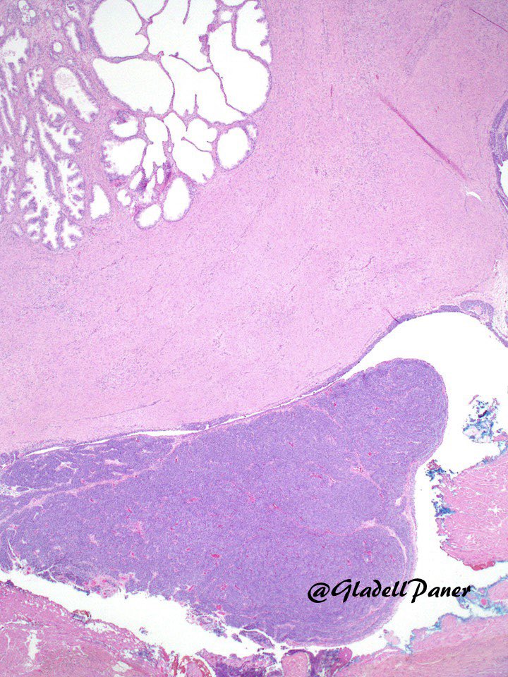Gladell Paner, MD (@gladellpaner) on Twitter photo Nice example of the rare Inverted #urothelial papilloma arising from prostatic #urethra, incidentally encountered on radical prostatectomy.
PMID: 16861968 by <a href="/rovingatuscap/">Samson W. Fine, MD</a>
#GUPath Nice example of the rare Inverted #urothelial papilloma arising from prostatic #urethra, incidentally encountered on radical prostatectomy.
PMID: 16861968 by <a href="/rovingatuscap/">Samson W. Fine, MD</a>
#GUPath