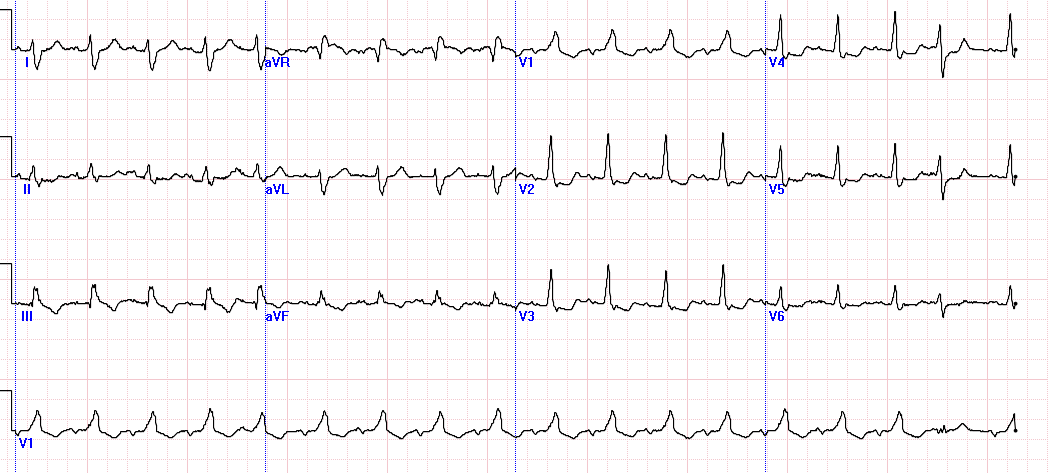 Severe chest pain w mildly elevated troponin. Persistent pain despite meds, repeat EKG. What's the culprit &amp; EKG pattern? <a href="/EM_RESUS/">Sam Ghali, M.D.</a> &amp; <a href="/smithECGBlog/">Stephen W. Smith</a> will probably know this in 10 seconds. 
#MedStudentTwitter Hint: This artery can be "electrically silent".