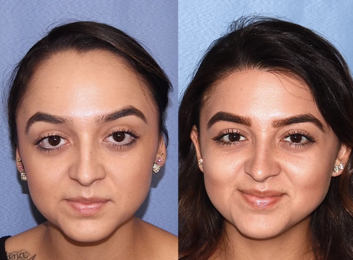the-cosmetic-lane-on-twitter-forehead-reduction-surgery-https-t-co