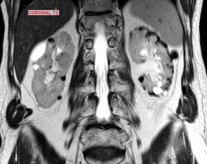 voxelmator's tweet photo. GU imaging quiz !🎓
Bilateral perirenal and renal lesions, mainly predominant on the left side. No enhancement. Your diagnosis ?
📌Answer and explanations next week...
#GUimaging @CHU_Lille #greatradiologyresidents #kidney #imaging https://t.co/e9djUsc3vU