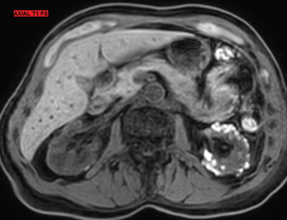 GU imaging quiz !🎓
Bilateral perirenal and renal lesions, mainly predominant on the left side. No enhancement. Your diagnosis ?
📌Answer and explanations next week...
#GUimaging <a href="/CHU_Lille/">CHU de Lille</a> #greatradiologyresidents #kidney #imaging